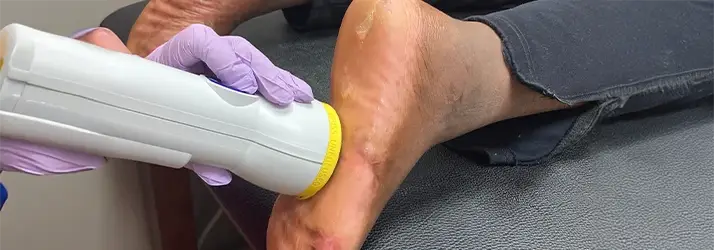 Neuropathy Cordova TN Softwave Therapy Foot Neuropathy Cordova TN Softwave Therapy Foot