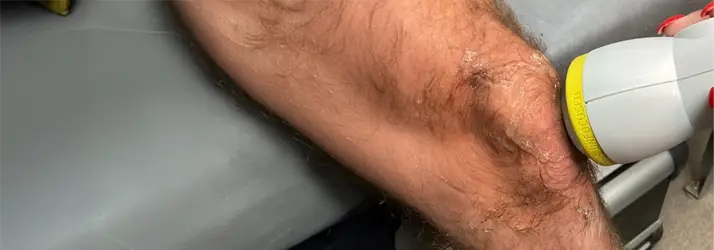 Neuropathy Cordova TN Softwave Therapy Knee Neuropathy Cordova TN Softwave Therapy Knee